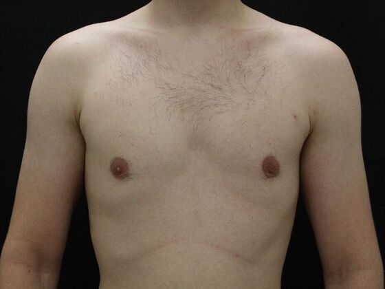 Gynecomastia Case 9 - After
