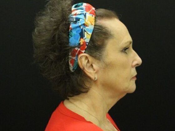 Face & Neck Lifts: Case 47 - Before