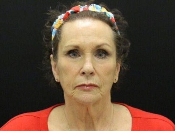 Face & Neck Lifts: Case 47 - Before