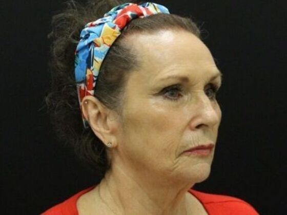 Face & Neck Lifts: Case 47 - Before