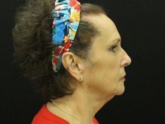 Non-Surgical: Case 10 - Before