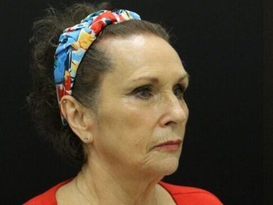 Non-Surgical: Case 10 - Before