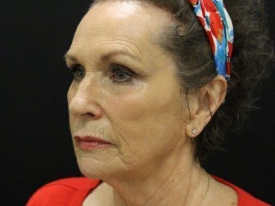 Non-Surgical: Case 10 - Before