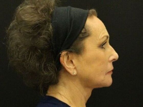 Non-Surgical: Case 10 - After