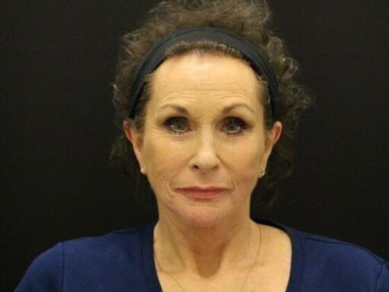 Non-Surgical: Case 10 - After