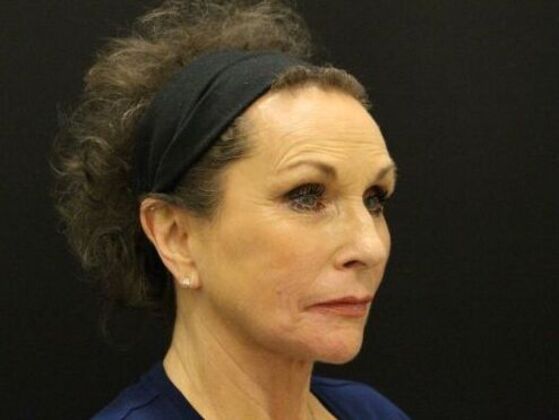 Non-Surgical: Case 10 - After