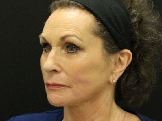 Non-Surgical: Case 10 - After