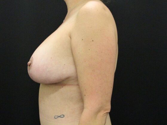 Breast Augmentation Exchange/Revision: Case 23 - After