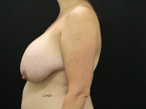 Breast Augmentation Exchange/Revision: Case 23 - Before