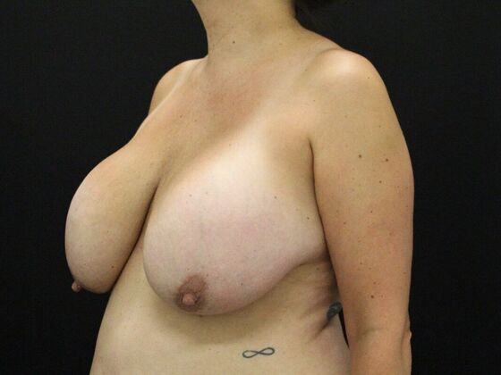 Breast Augmentation Exchange/Revision: Case 23 - Before