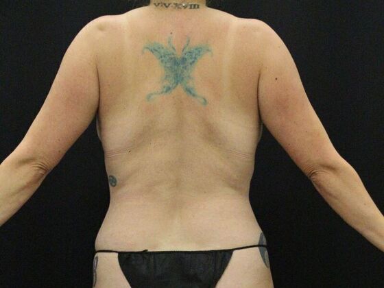 Tummy Tuck Case 74 - After