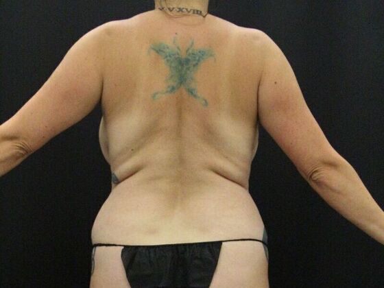 Tummy Tuck Case 74 - Before