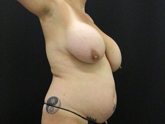 Tummy Tuck: Case 74 - Before