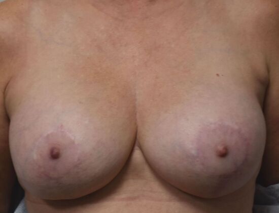 Breast Augmentation w/ Lift Case 550 - After
