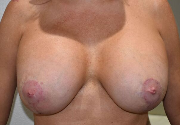 Breast Revision: Case 260 - After