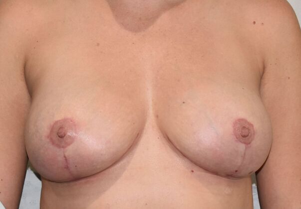 Breast Lift (Mastopexy) Case 224 - After