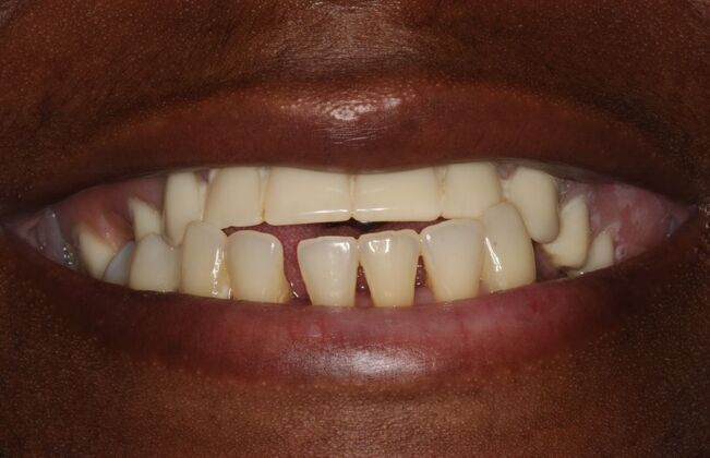 Implants Case 1 - Smile XZ - Before