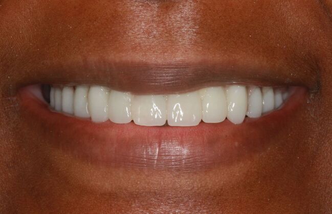 Implants Case 2 - Smile XZ - After