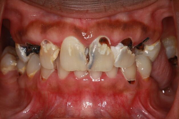 Implants Case 2 - Smile XZ - Before