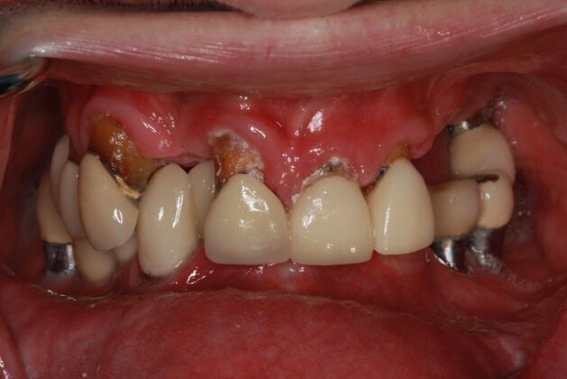 Implants Case 3 - Smile XZ - Before