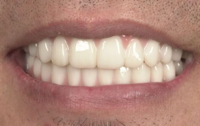 Implants Case 5 - Smile XZ - After