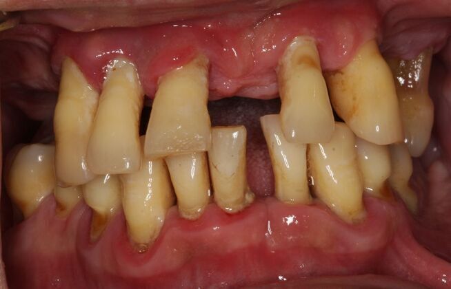 Implants Case 5 - Smile XZ - Before