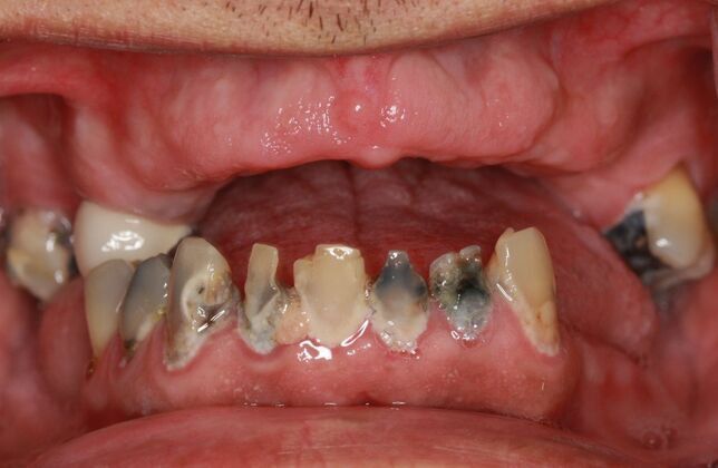 Implants Case 6 - Smile XZ - Before