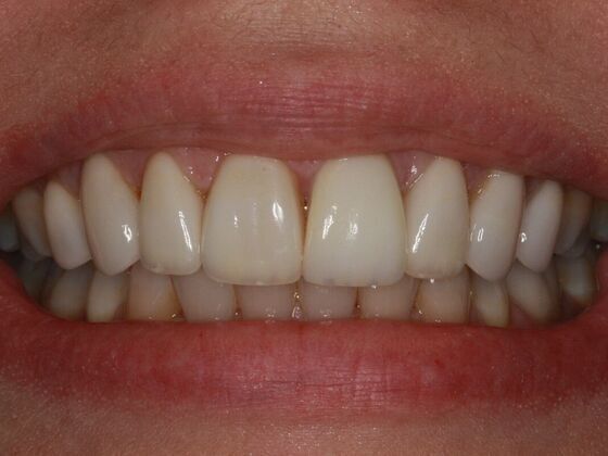 Implants Case 7 - Single Implant - After