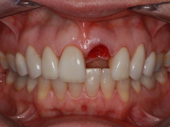 Implants Case 7 - Single Implant - Before