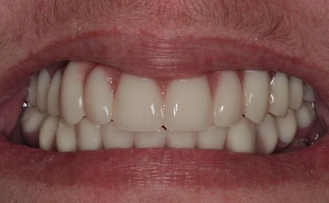 Implants Case 8  - Smile XZ - After