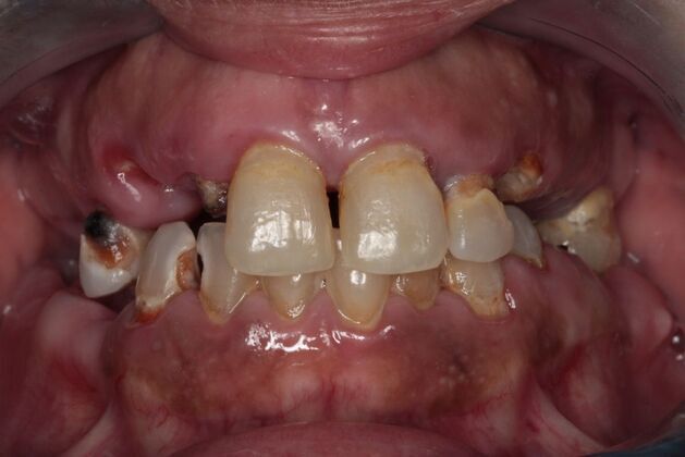 Implants Case 8  - Smile XZ - Before