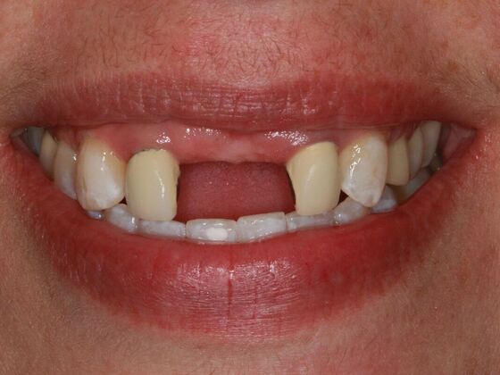 Implants Case 9  - Single Implants - Before