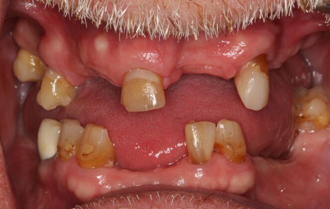 Implants Case 10  - Smile XZ - Before