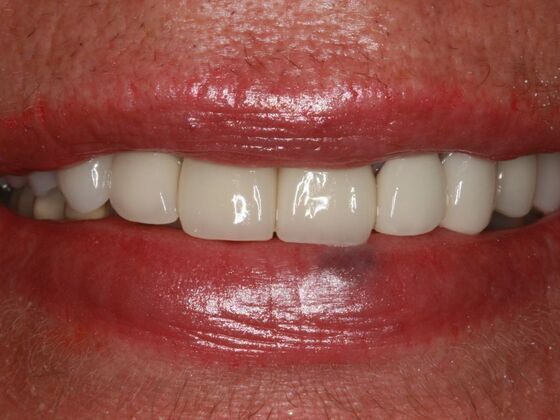 Cosmetic Case 3 - After