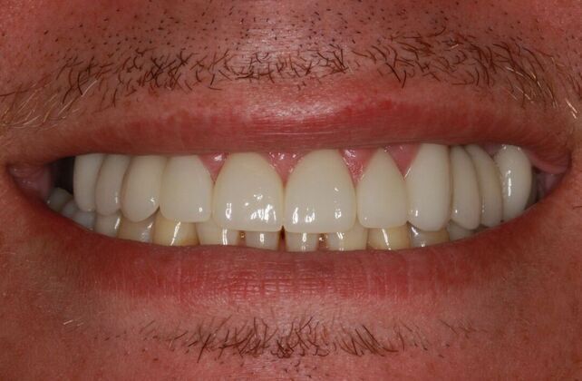 Cosmetic Case 4 - After