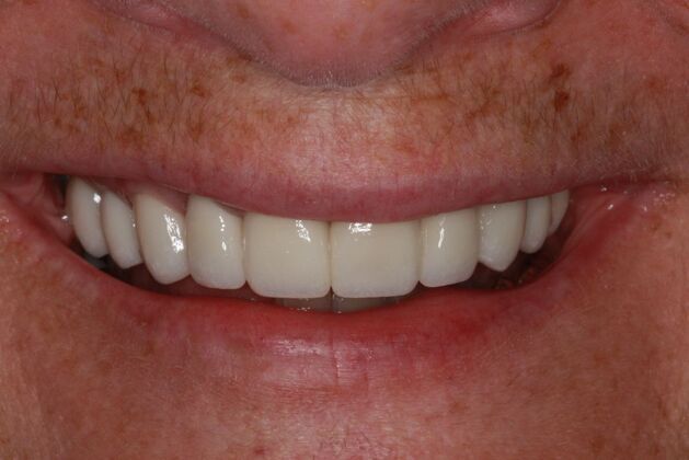 Cosmetic Case 8 - After