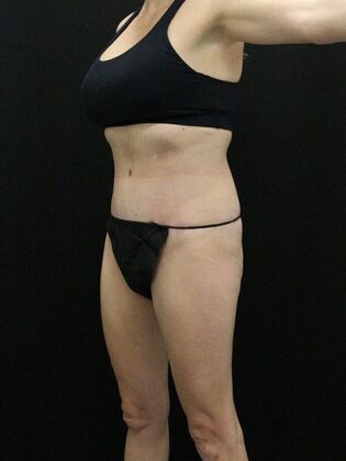 Tummy Tuck: Case 54 - After