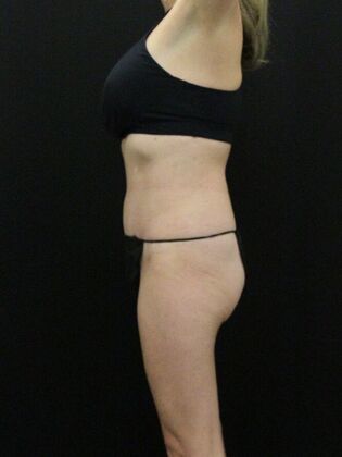 Tummy Tuck: Case 54 - After