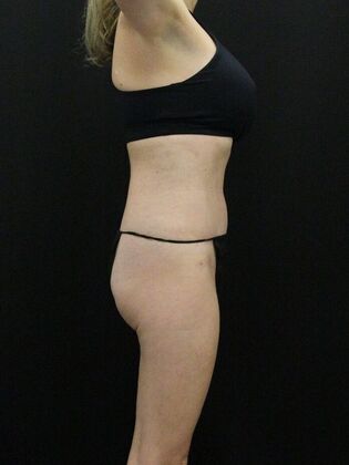 Tummy Tuck: Case 54 - After