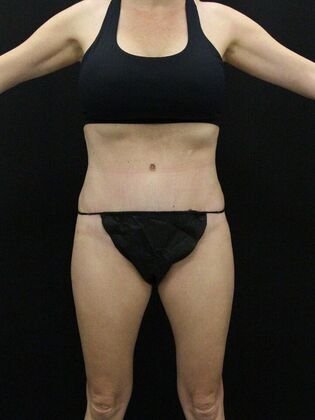 Tummy Tuck Case 54 - After