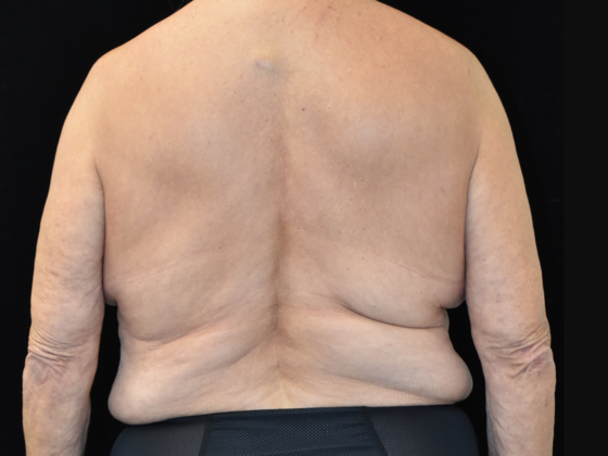 Torsoplasty: Case 2 - Before