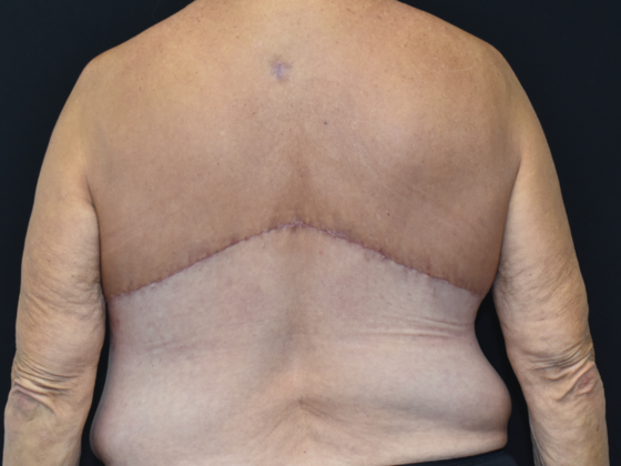 Torsoplasty: Case 2 - After