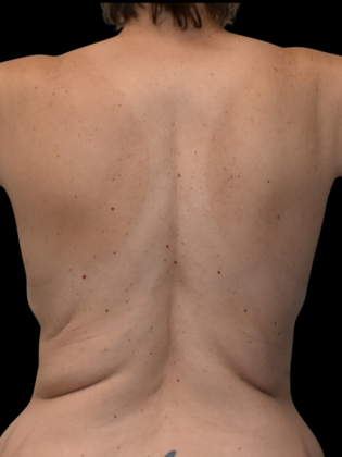 Torsoplasty: Case 3 - Before