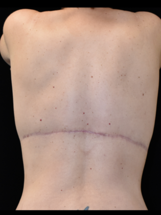 Torsoplasty: Case 3 - After