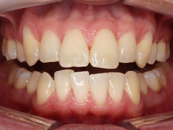 Orthodontics : Alex -  Braces - Before