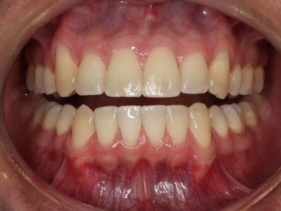 Orthodontics : Alex -  Braces - After