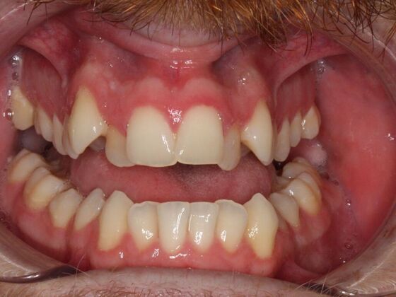 Orthodontics : Caleb  - Invisalign - Before