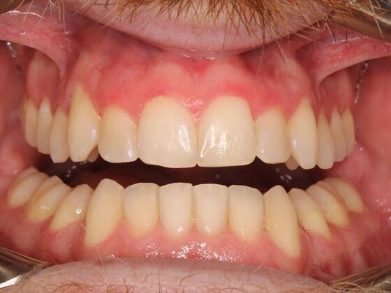 Orthodontics : Caleb  - Invisalign - After