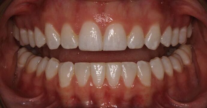 Orthodontics : Cassie - Invisalign - After