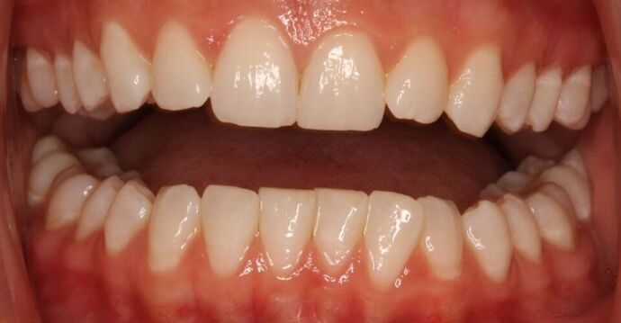 Orthodontics : Cassie - Invisalign - Before